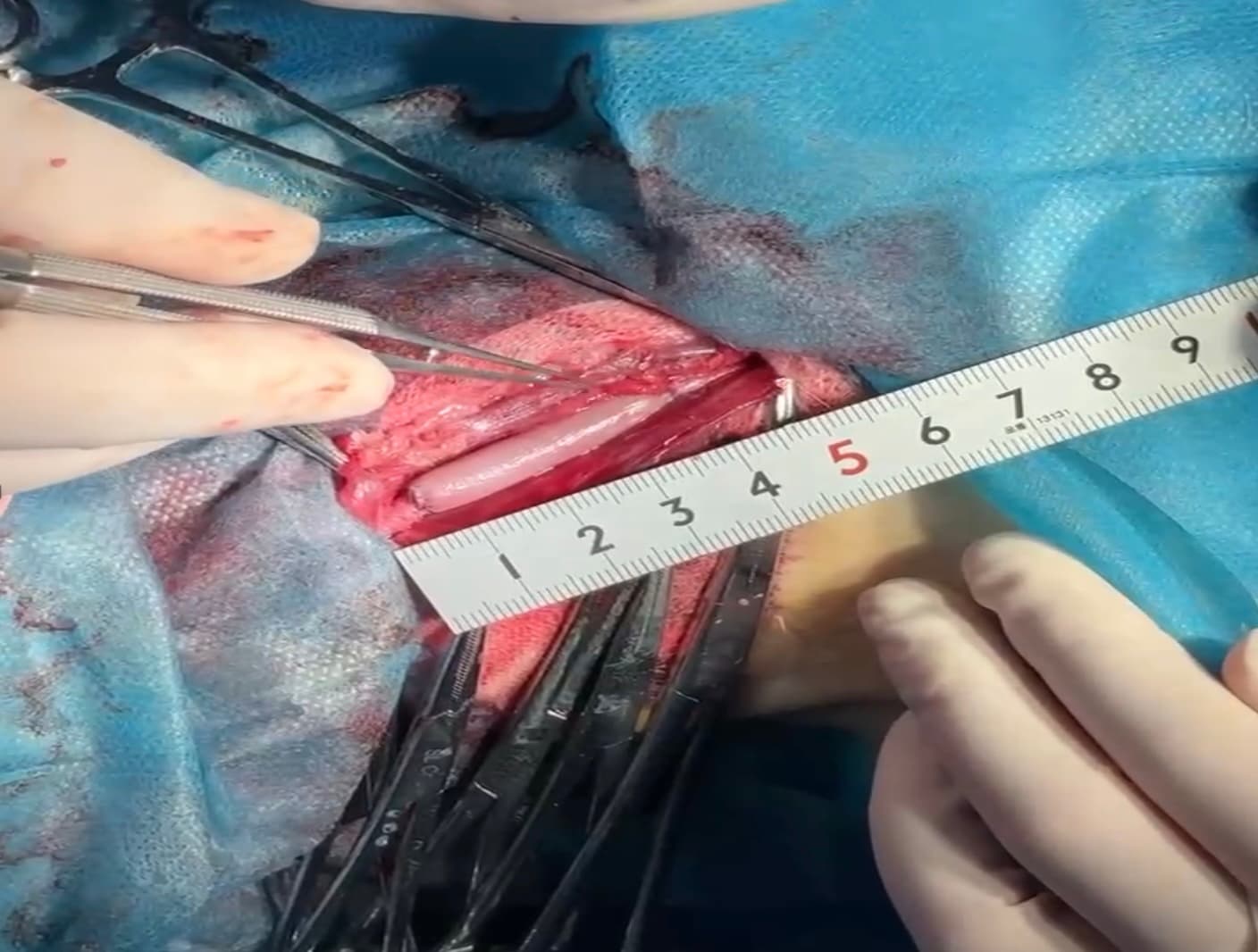 Tissue-engineered blood vessel during preclinical implantation surgery